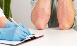 Infecția cu scabie